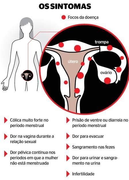 sintomas da endometriose